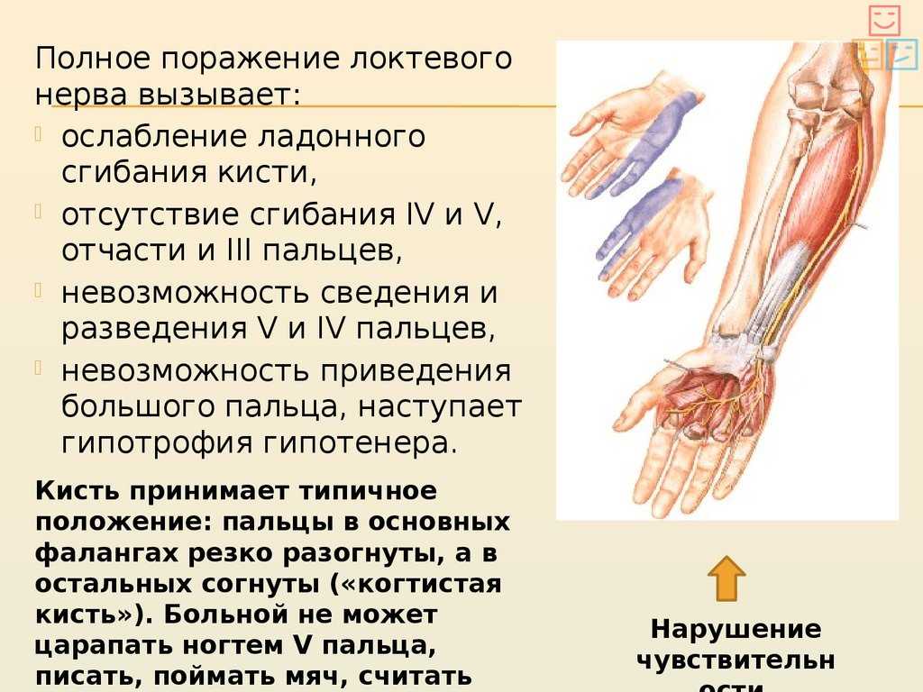 Невропатия лучевого нерва мкб. Нейропатия локтевого нерва клиника. Невропатия локтевого нерва симптомы. Поражение сенсорных волокон нервов верхних конечностей. Поражение локтевого нерва руки.